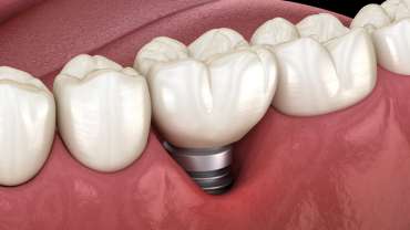 Implantes dentales: ¿cómo puedes evitar la periimplantitis?