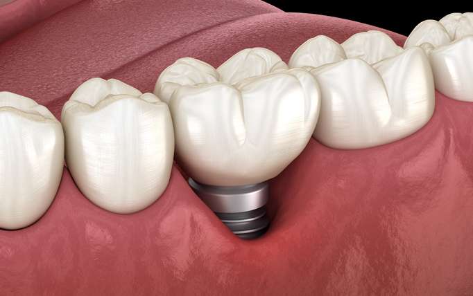 Implantes dentales: ¿cómo puedes evitar la periimplantitis?