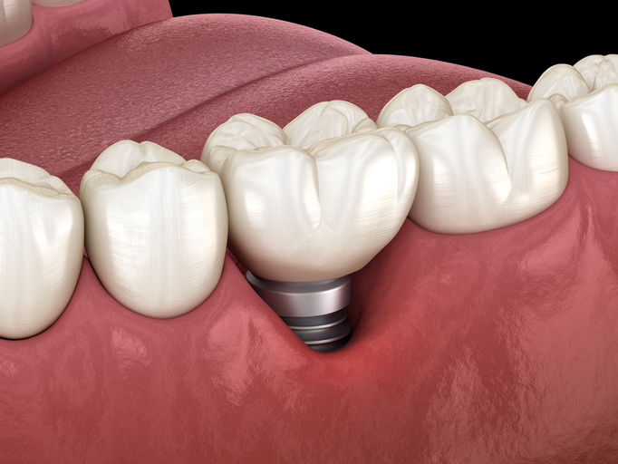 Implantes dentales: ¿cómo puedes evitar la periimplantitis?